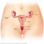 cauze cancer vaginal