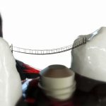 Implant dentar in Bucuresti – avantaje si dezavantaje