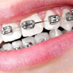 Tratament de indreptare a dintilor