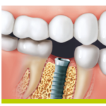 Tot ce trebuie sa stii inainte sa iti pui un implant dentar