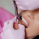 5 lucruri de stiut inaintea unei extractii dentare